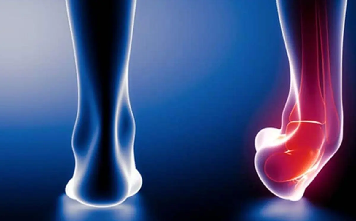 بلافاصله پس از پیچ خوردن پا چه باید کرد؟