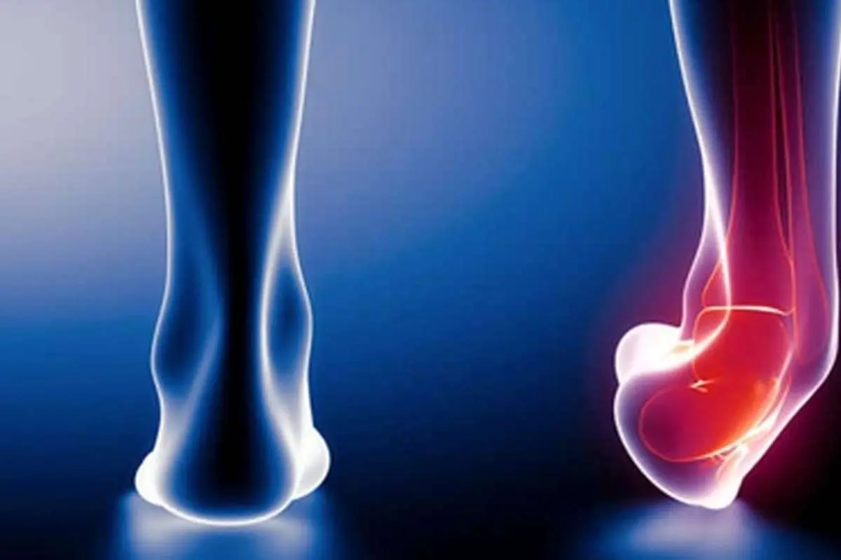 بلافاصله پس از پیچ خوردن پا چه باید کرد؟