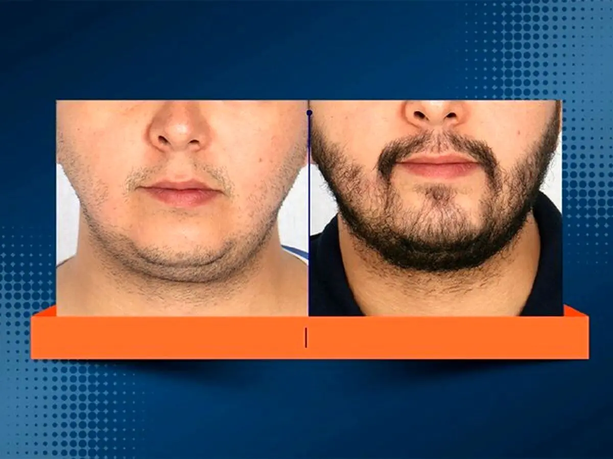 کاشت ریش مخصوص چه کسانی است و چگونه انجام می­شود؟