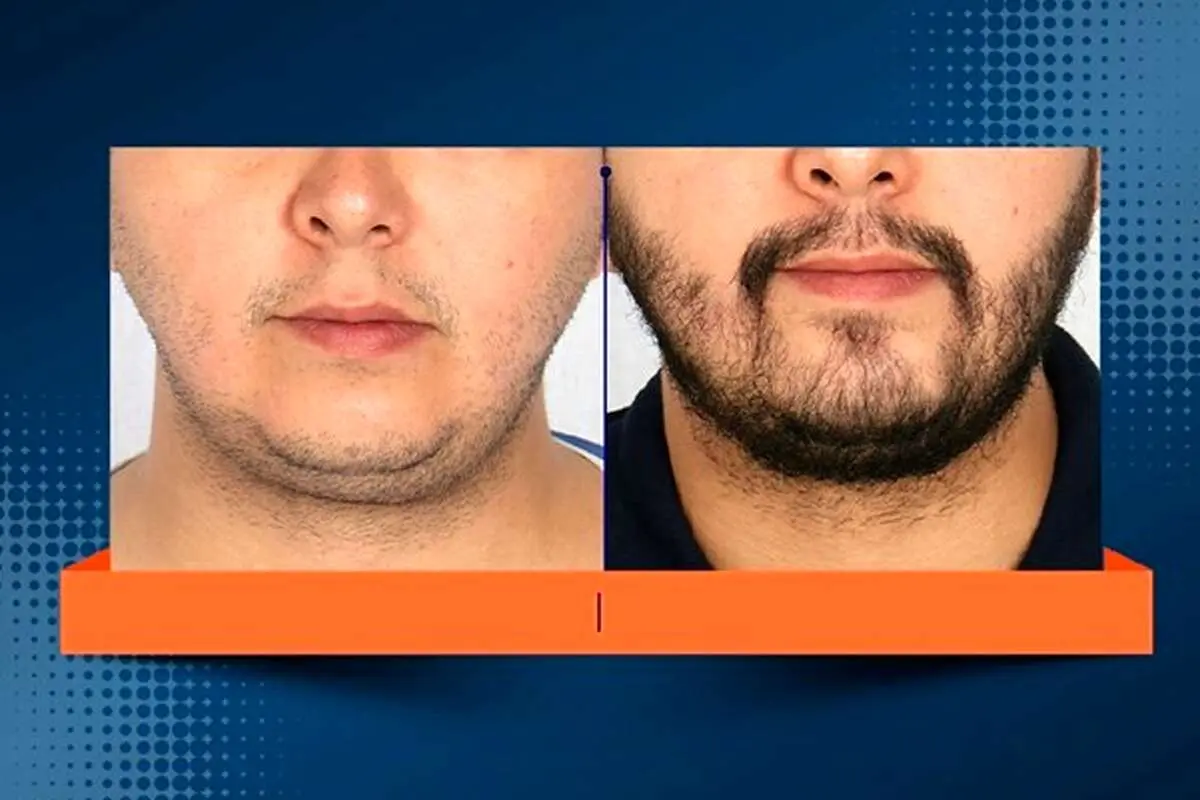 کاشت ریش مخصوص چه کسانی است و چگونه انجام میشود؟