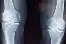 امید تازه برای درمان آرتروز