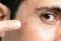 نشانه‌های اولیه سرطان پوست
