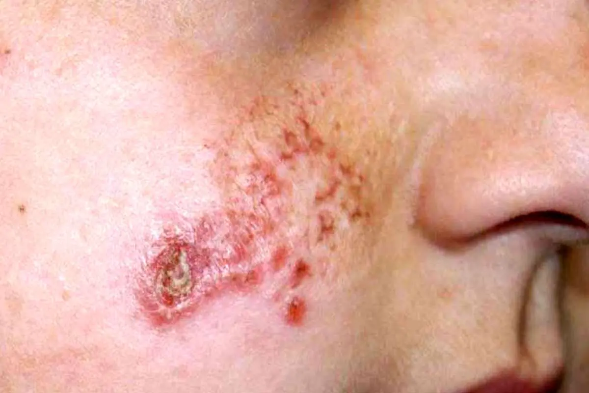 هشدار درباره شیوع انگل خطرناک لیشمانیوز