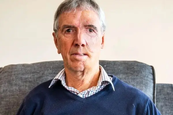  عکس؛ بازسازی شگفت‌انگیز چهره یک دوچرخه‌سوار پس از تصادف دلخراش