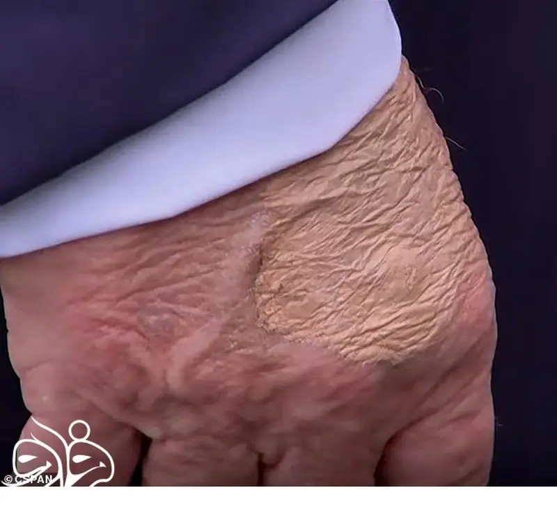 التهاب پوست دست ترامپ