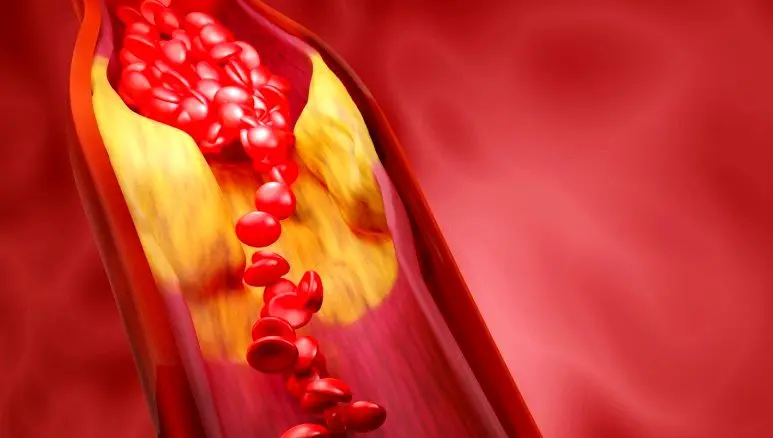 مهم‌ترین راهکار کنترل چربی خون برای افراد بالای ۳۰ سال
