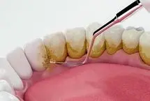 (ویدیو) راهکار‌های پیشگیری از تشکیل جرم دندان