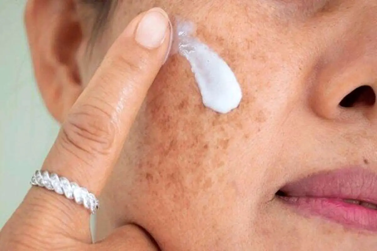 لکههای پوستی بارداری؛ چرا ایجاد میشوند و چگونه از آنها پیشگیری کنیم؟