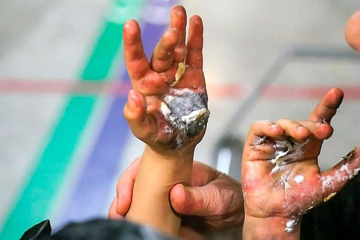 مصدوم شدن ۷۵ نفر در تهران و قطع عضو یک کودک