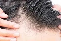 ویتامینی که کمبود آن سبب ریزش مو می‌شود