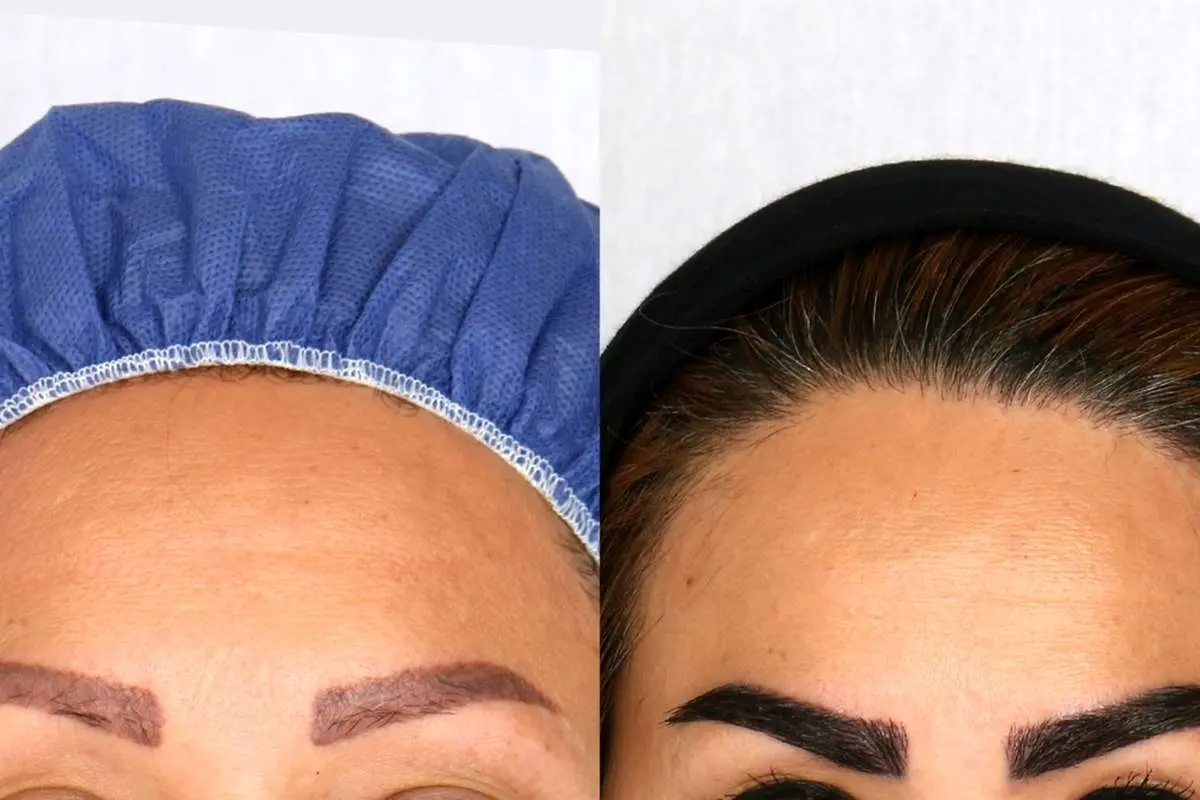 ابروهایی بینقص با روش کاشت ابرو FUE؛ رمز زیبایی در قاب صورت شما
