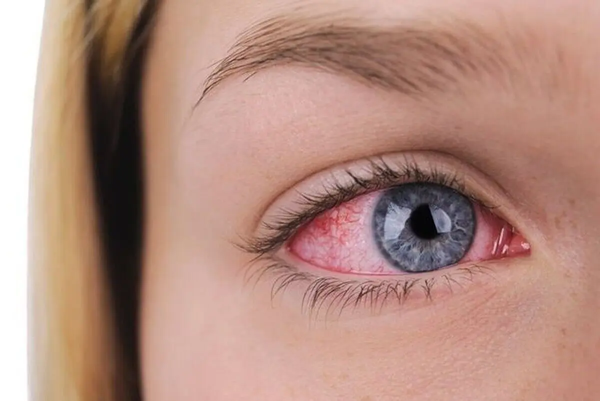 ببینید؛ علت خشکی چشم چیست؟