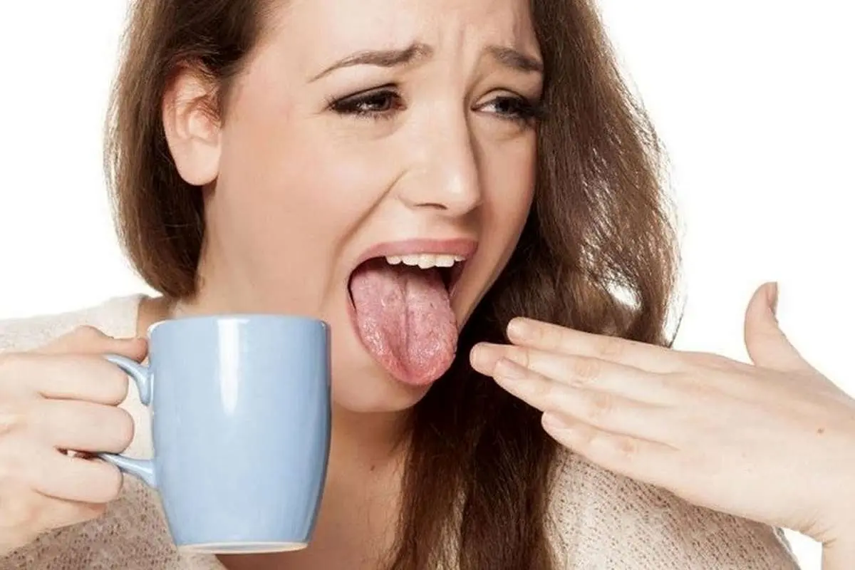 چند راهکار طبیعی برای تسکین سوختگی زبان