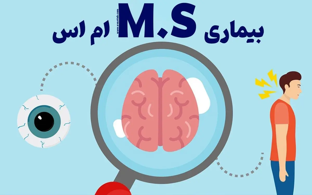 کشف راهی جدید برای کنترل ام اس