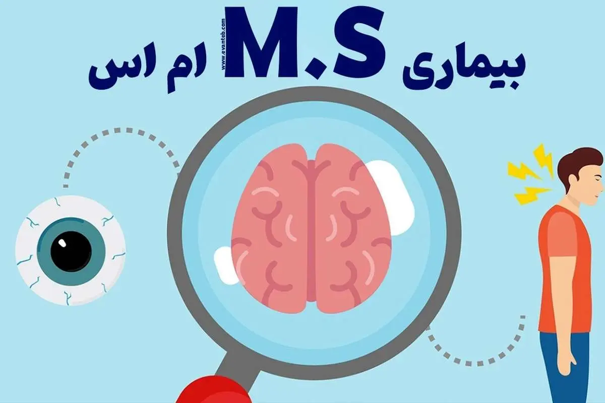 کشف راهی جدید برای کنترل ام اس