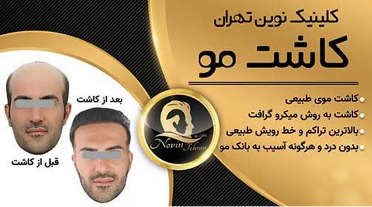 عوارض کاشت مو