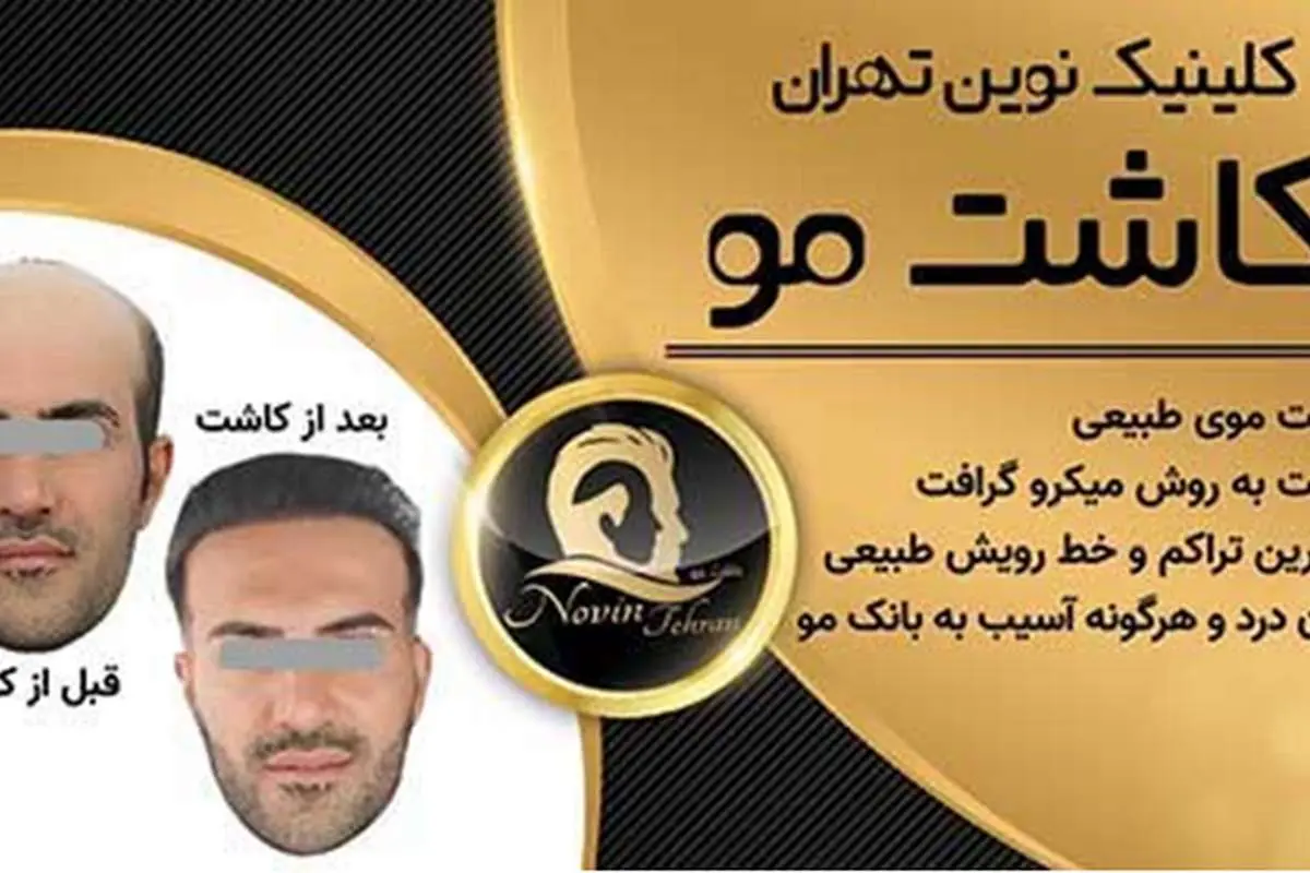 عوارض کاشت مو