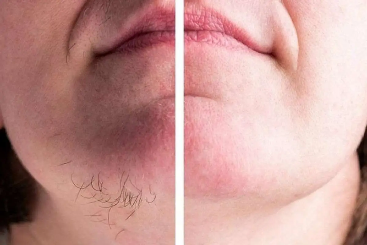 ۶ چیزی که نمیدانستید موهای زائد صورت را بیشتر میکنند