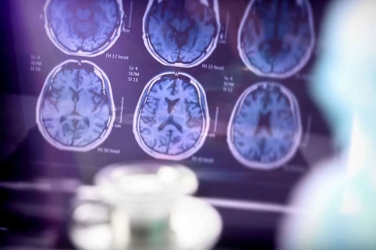 آیا می‌توان از سکته مغزی جلوگیری کرد؟