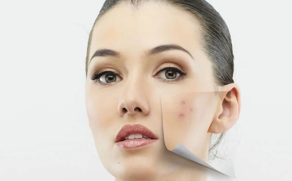 چگونه از شر لکه‌های پوستی خلاص شویم؟