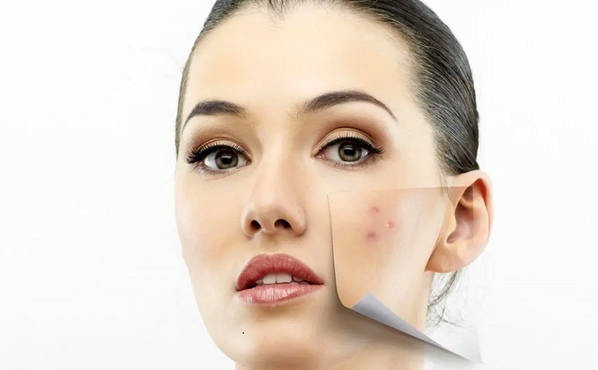 چگونه از شر لکه‌های پوستی خلاص شویم؟