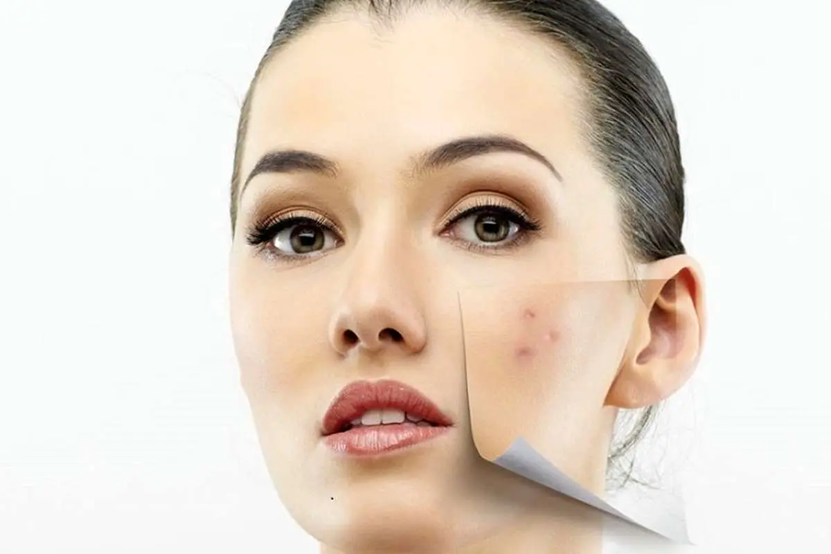 چگونه از شر لکه‌های پوستی خلاص شویم؟