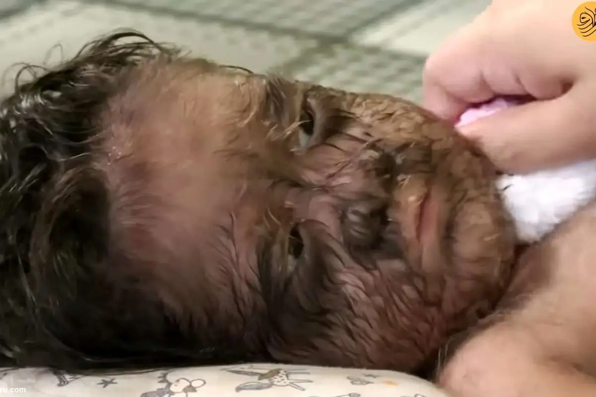 (تصاویر) دختر دو ساله با صورت پر از مو؛ دختری از بهشت یا کودک حیوانی!