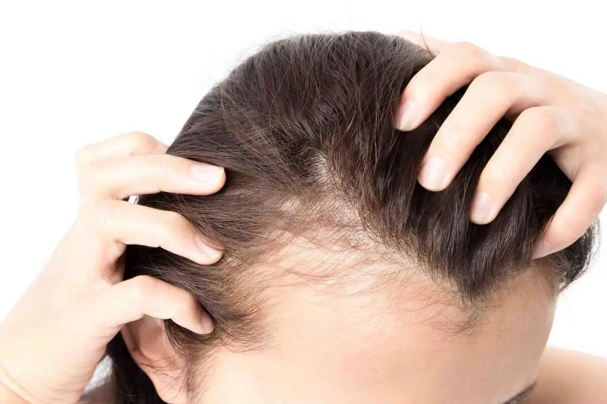 آیا میتوان از ریزش مو جلوگیری کرد؟
