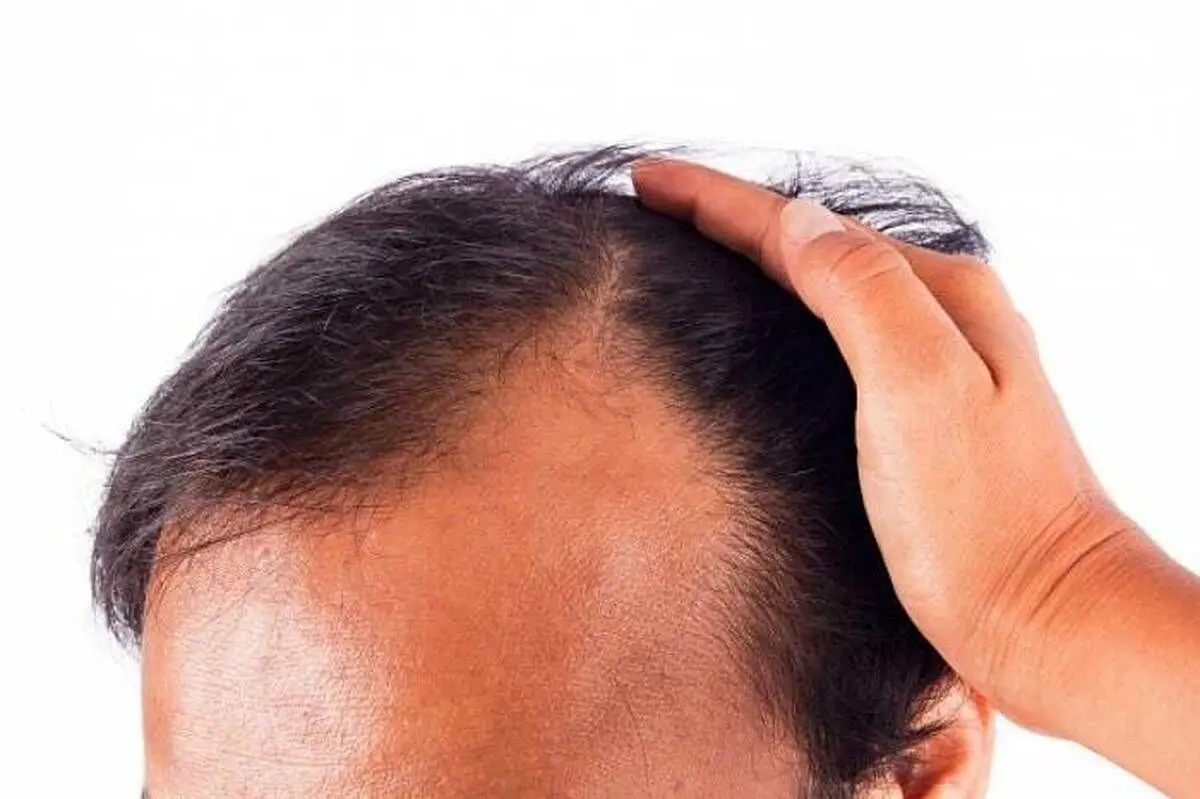 ۸ روش فوق‌العاده برای درمان ریزش موی شقیقه‌ها در زنان و مردان