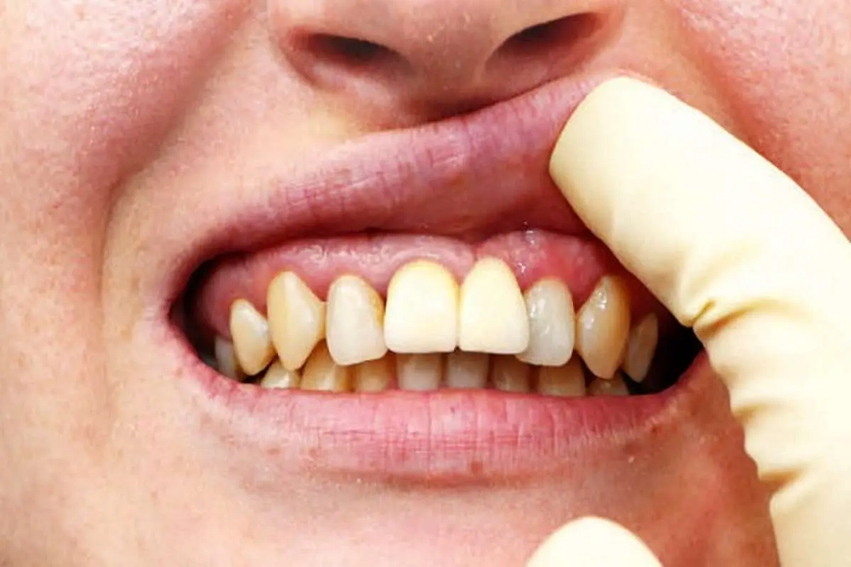 علتهای عقبرفتگی لثه چیست؟