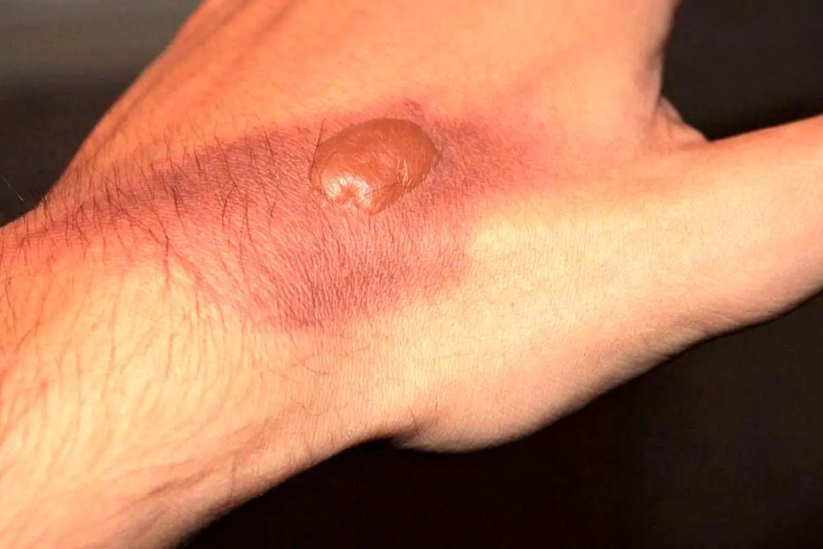 (ویدیو) چرا نباید تاولهای روی زخم را از بین ببرید؟!