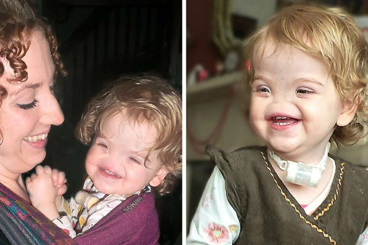 (تصاویر) ماجرای عجیب و تراژیک دختری که بدون بینی به دنیا آمده است