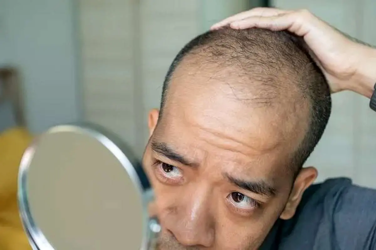 کمبود کدام ویتامین باعث ریزش مو می‌شود؟ / مصرف بیش از اندازه این دو ویتامین منجر به ریزش مو می‌شود!