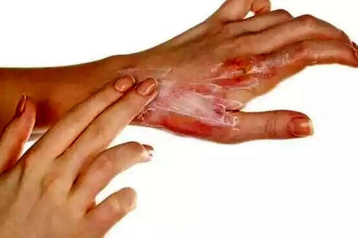با سوختگی‌ها و بریدگی‌ها چه باید کرد؟ / راهکار‌هایی مفید برای درمان اورژانسی و خانگی