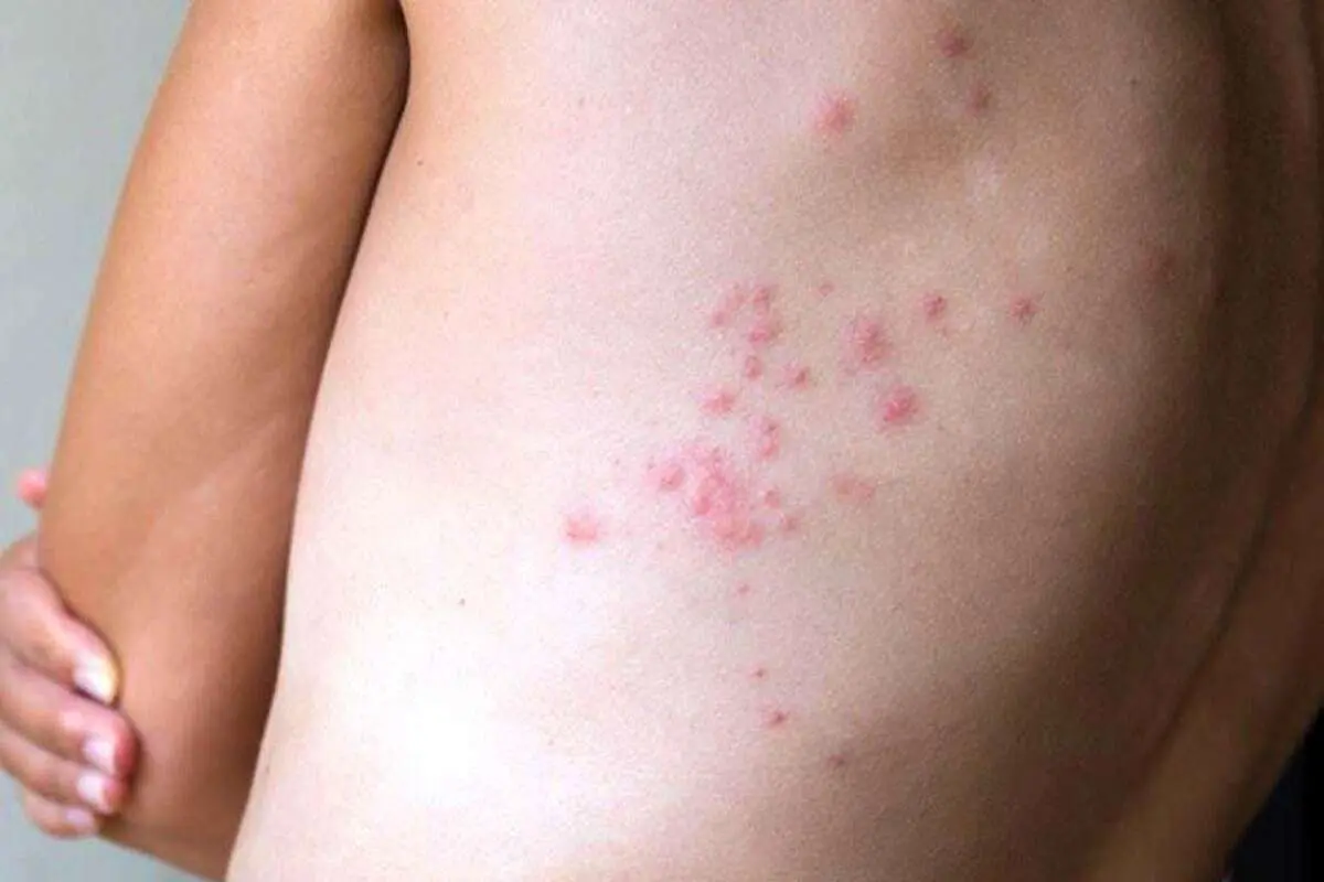 همزیستی با حشرات در خوابگاه‌های دانشجویی!