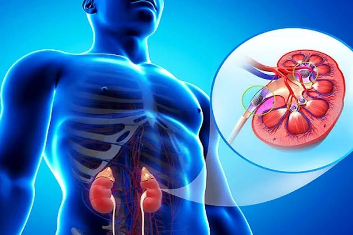 بهترین معجونهای خانگی برای دفع سنگ کلیه