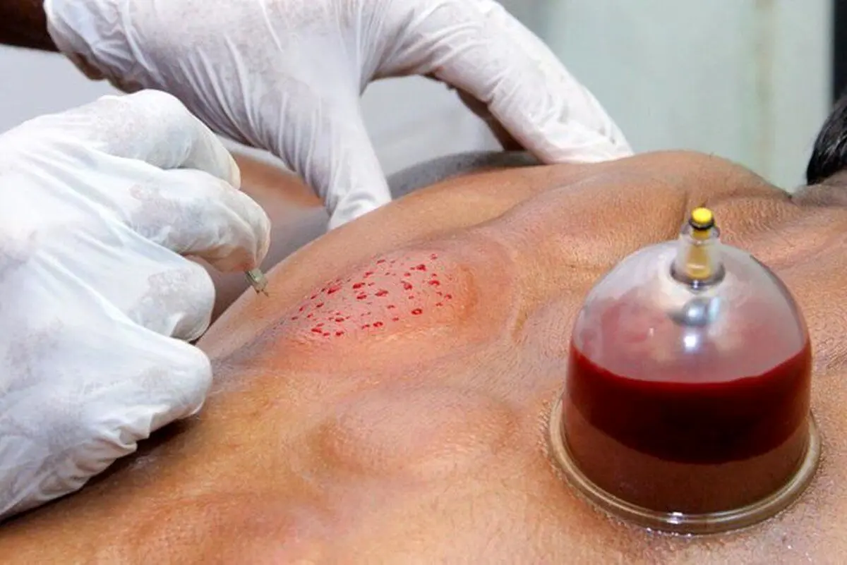 هشدار وزارت بهداشت درباره انجام ۳ کار در طب سنتی