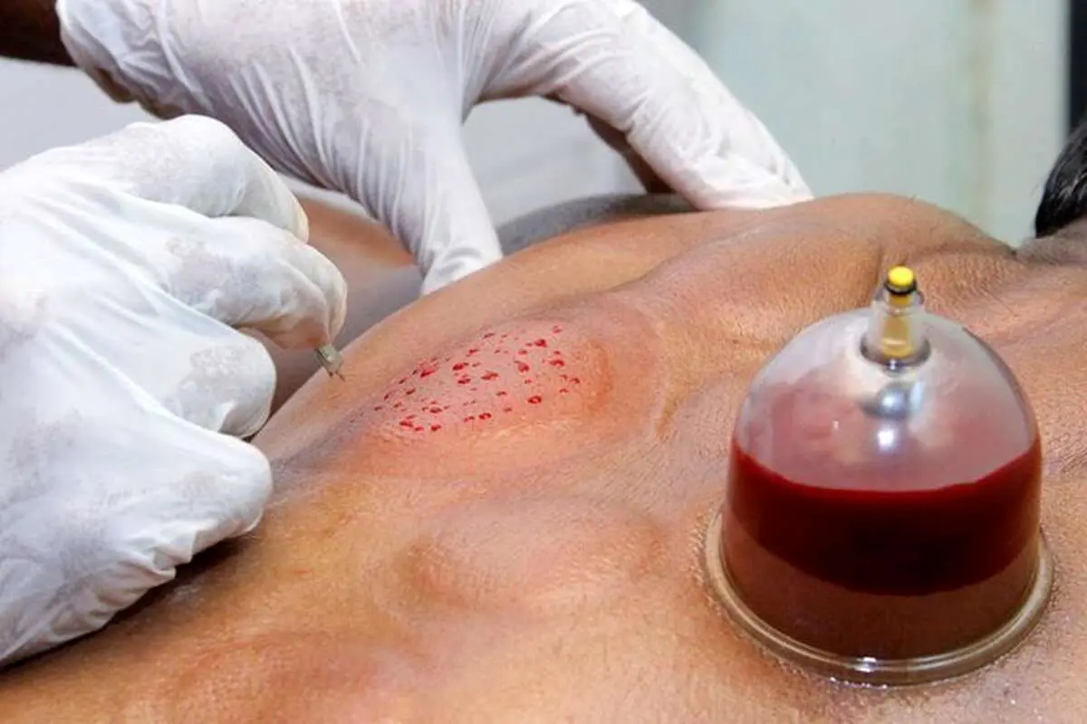 هشدار وزارت بهداشت درباره انجام ۳ کار در طب سنتی