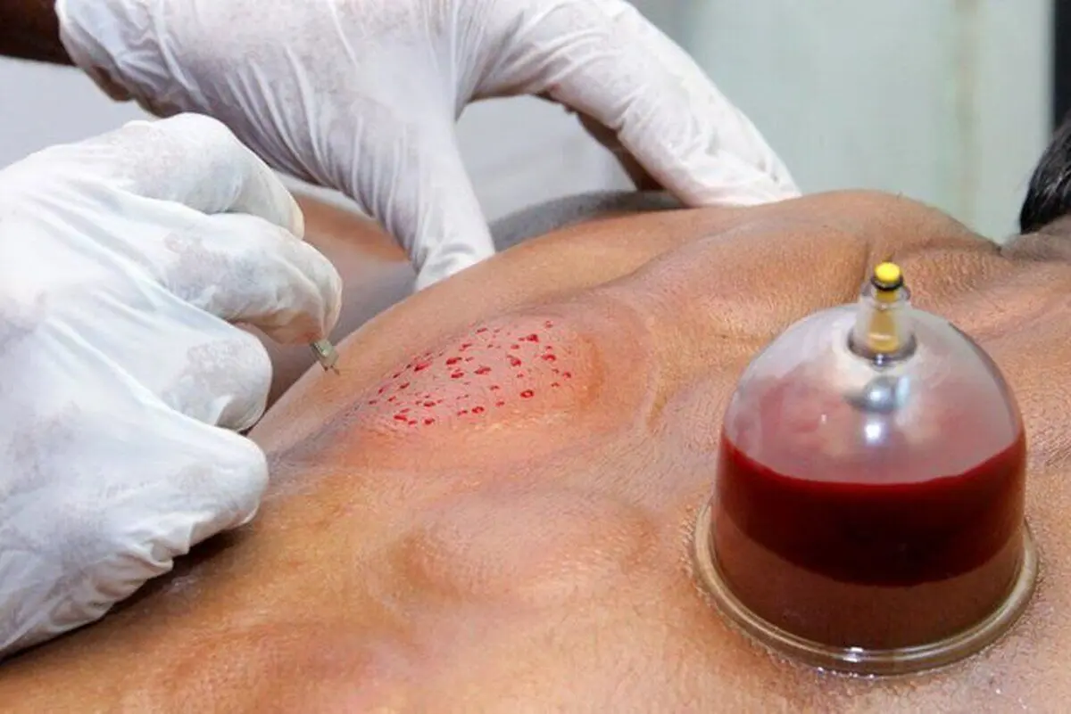 هشدار وزارت بهداشت درباره انجام ۳ کار در طب سنتی