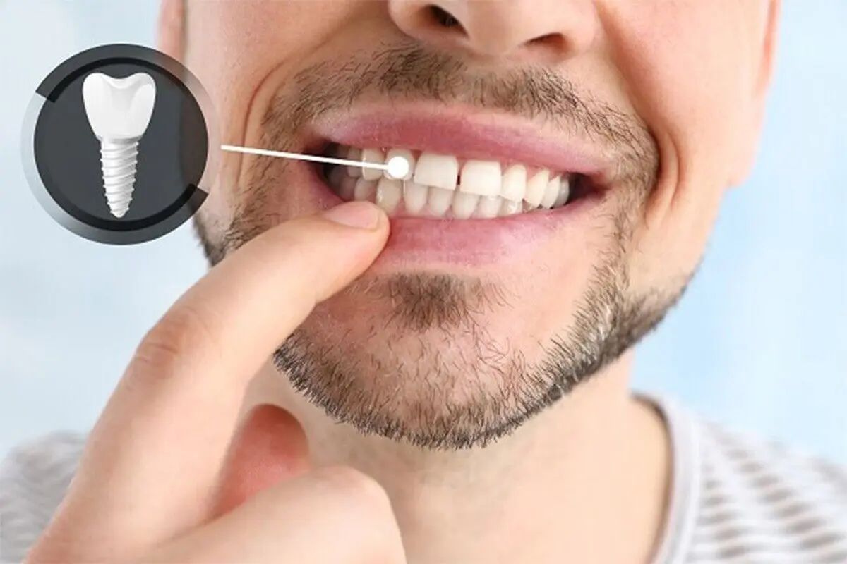 کاشت دندان بدون ایمپلنت چه مزایا و معایبی دارد؟