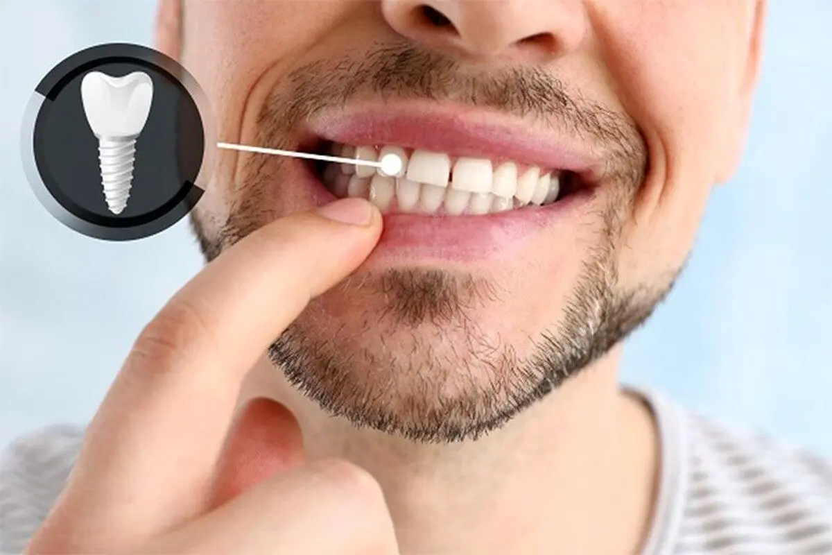 کاشت دندان بدون ایمپلنت چه مزایا و معایبی دارد؟