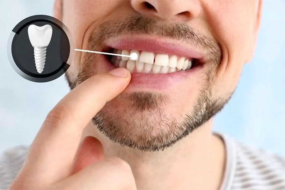 کاشت دندان بدون ایمپلنت چه مزایا و معایبی دارد؟