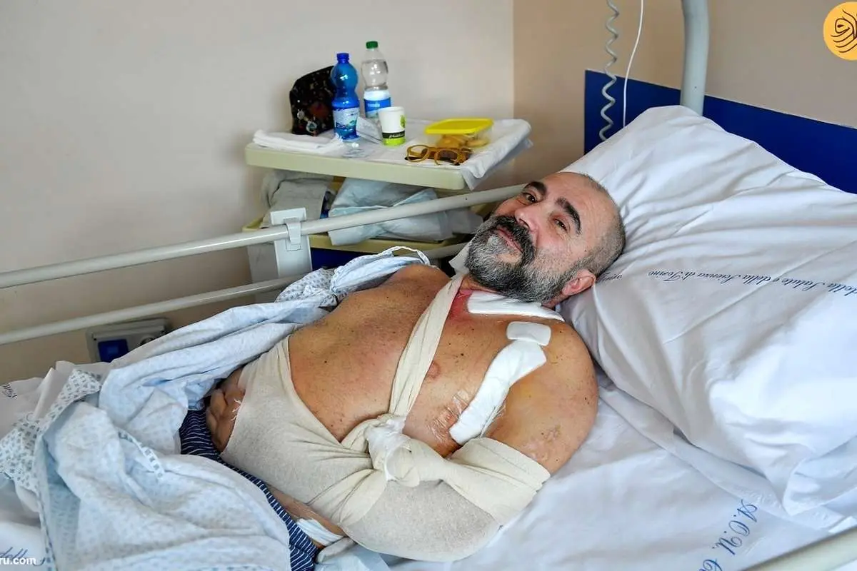 (ویدئو 16+)  پیوند بخشی از عصب پای یک مرد تصادف کرده به دستش
