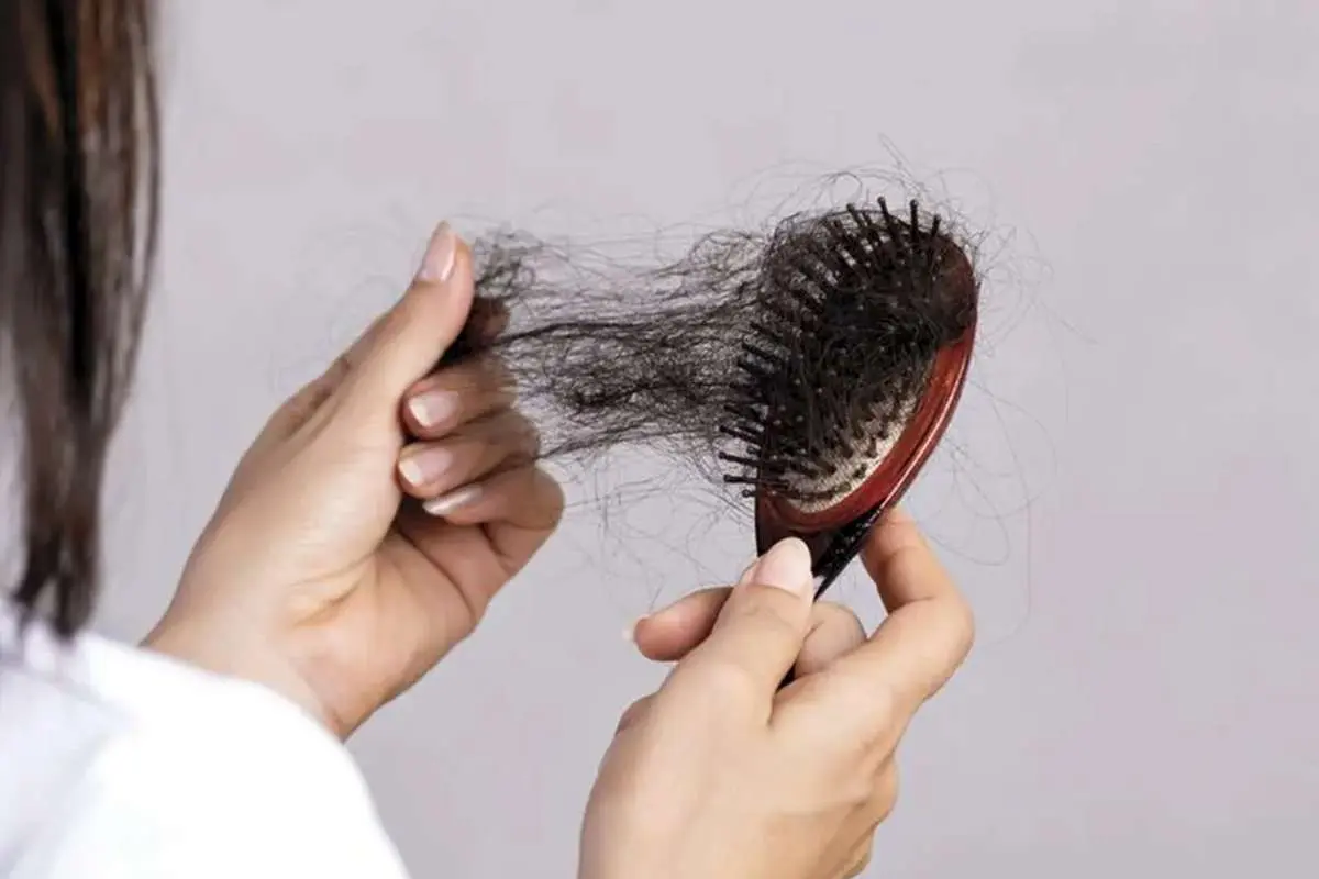 شایعترین علل ریزش مو