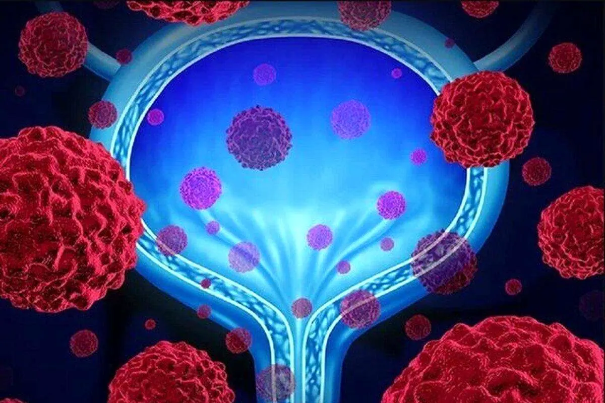 پنج توصیه مهم و ساده برای پاکسازی مثانه