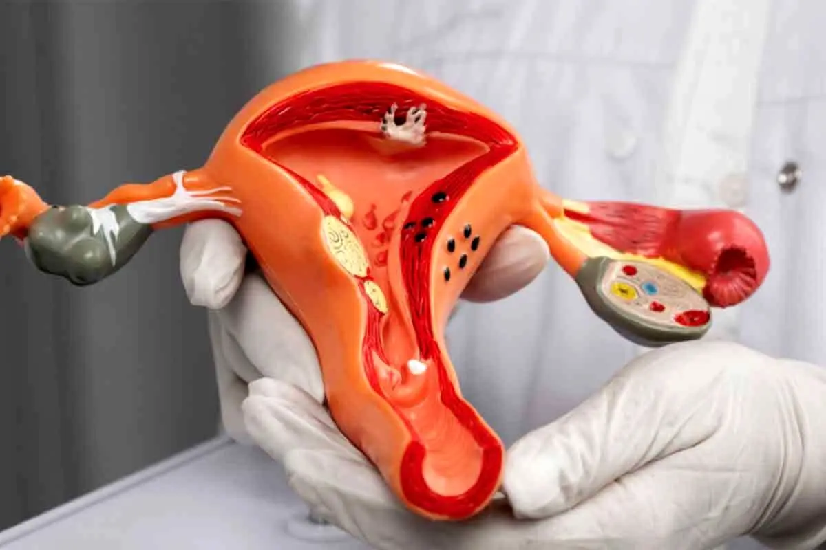 سندرم تخمدان پلی‌کیستیک، شایع‌ترین علت بی‌نظمی‌های قاعدگی