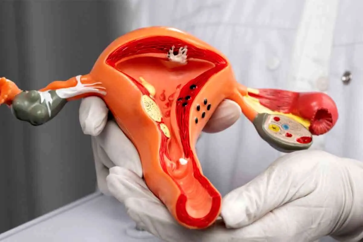 سندرم تخمدان پلی‌کیستیک، شایع‌ترین علت بی‌نظمی‌های قاعدگی