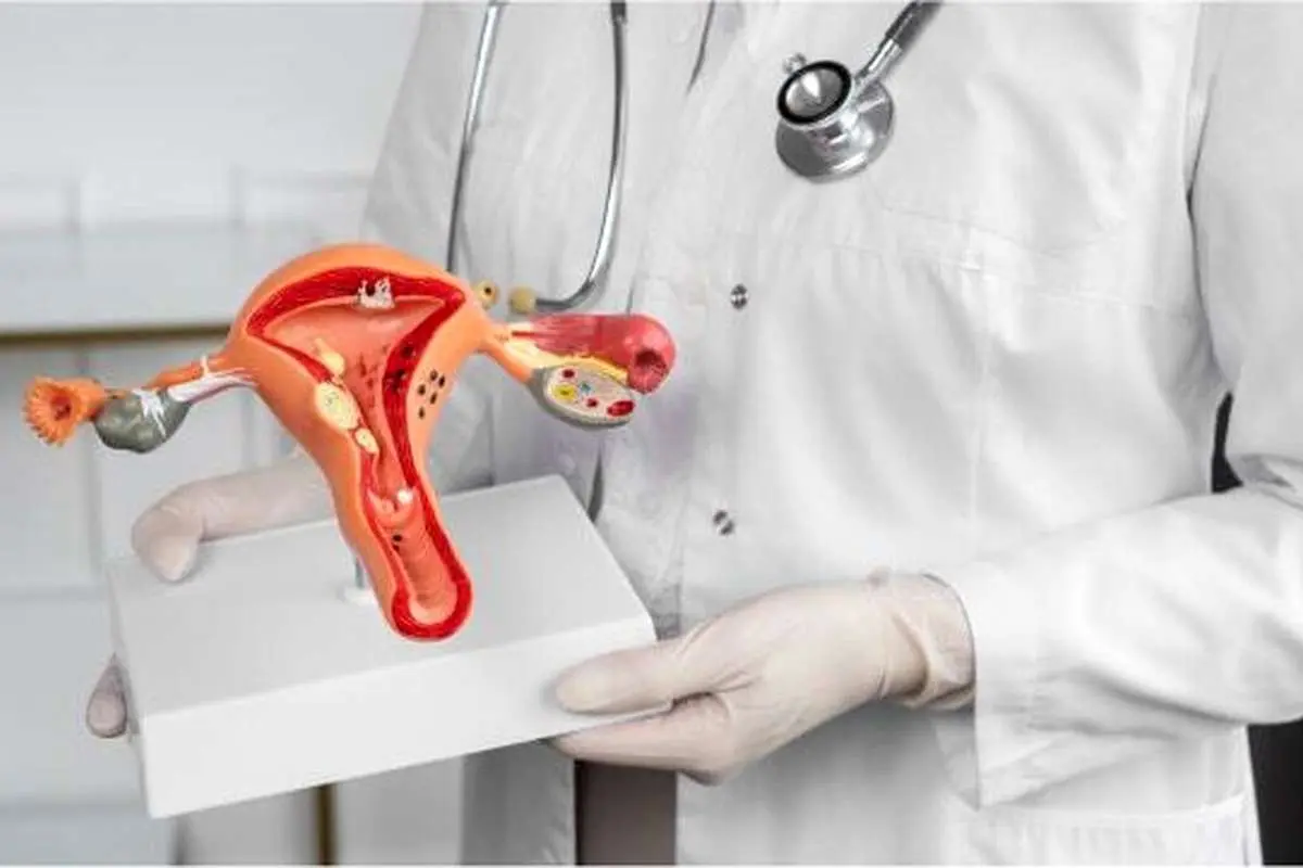 تنبلی تخمدان خطر مرگ در سنین پایین را افزایش می‌دهد