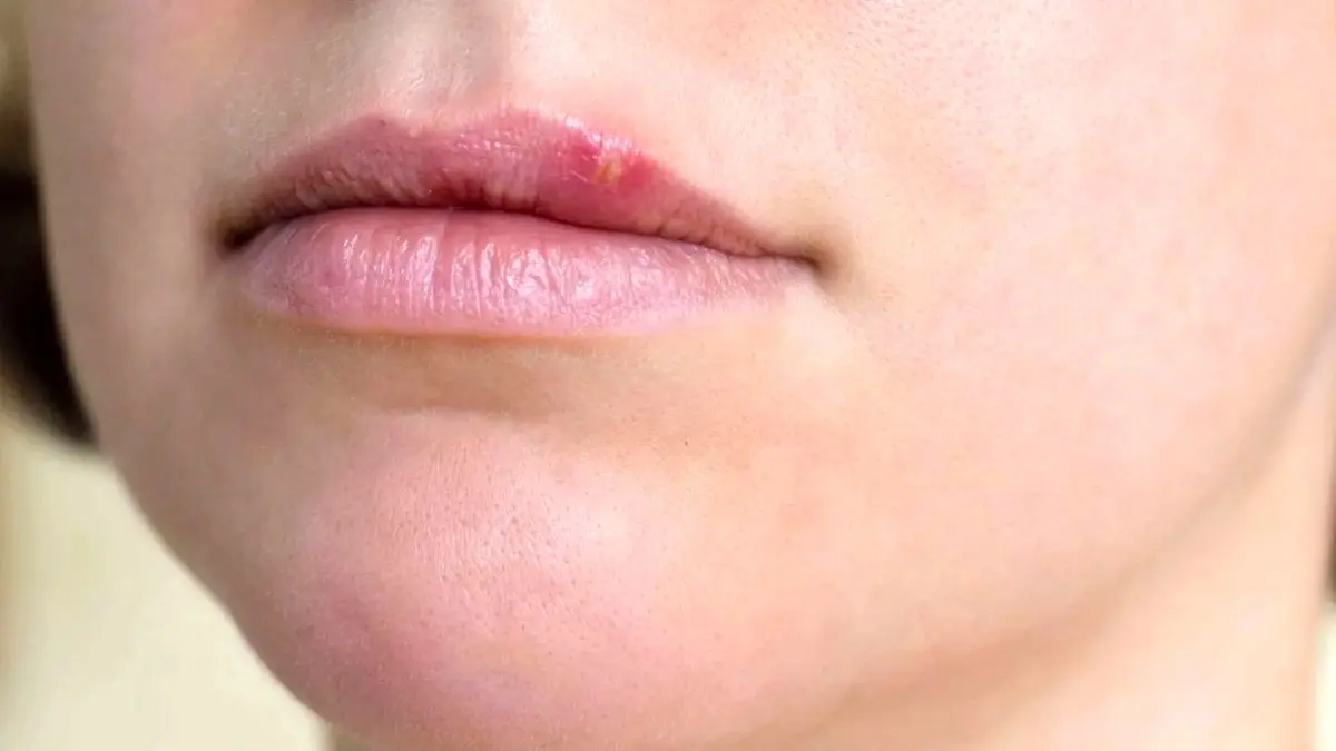ویروس تبخال ریسک ابتلا به زوال عقل را دو برابر می‌کند!