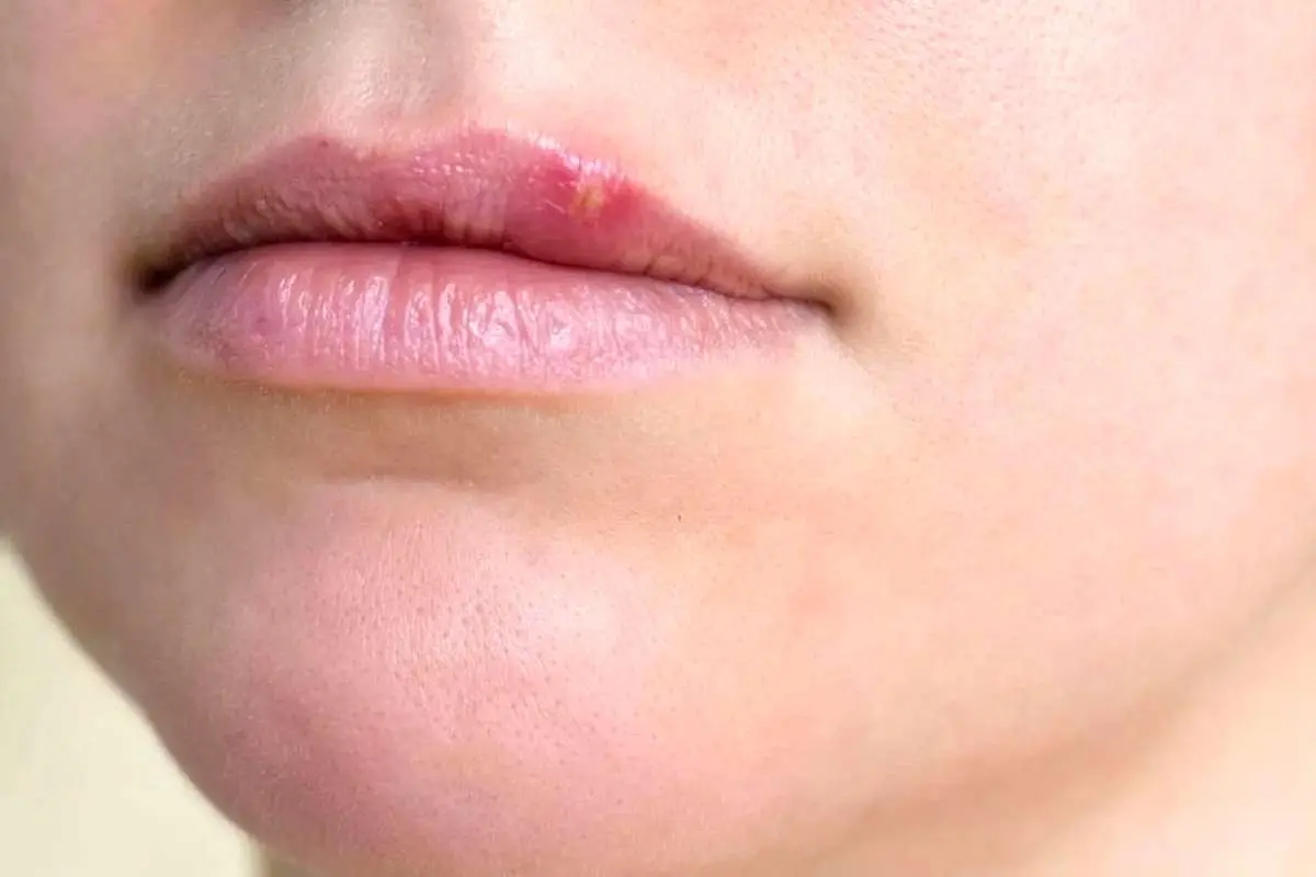 ویروس تبخال ریسک ابتلا به زوال عقل را دو برابر می‌کند!